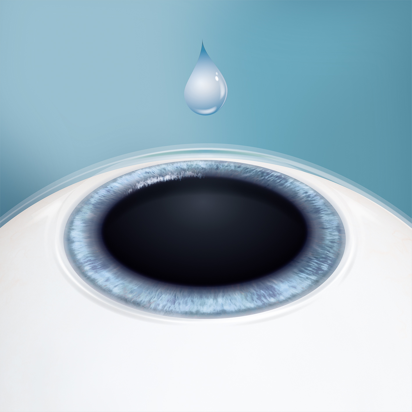 目薬で瞳孔を広げ、点眼麻酔を行います。角膜の縁を幅3mm弱切開します。