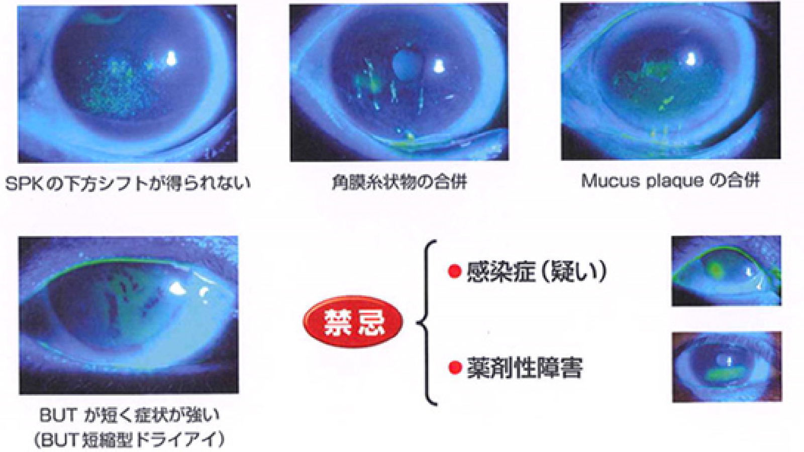 涙点プラグの良い適応と禁忌