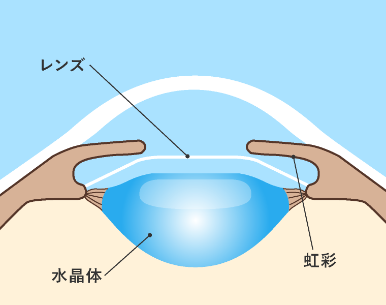 ICLによる近視回復の仕組み