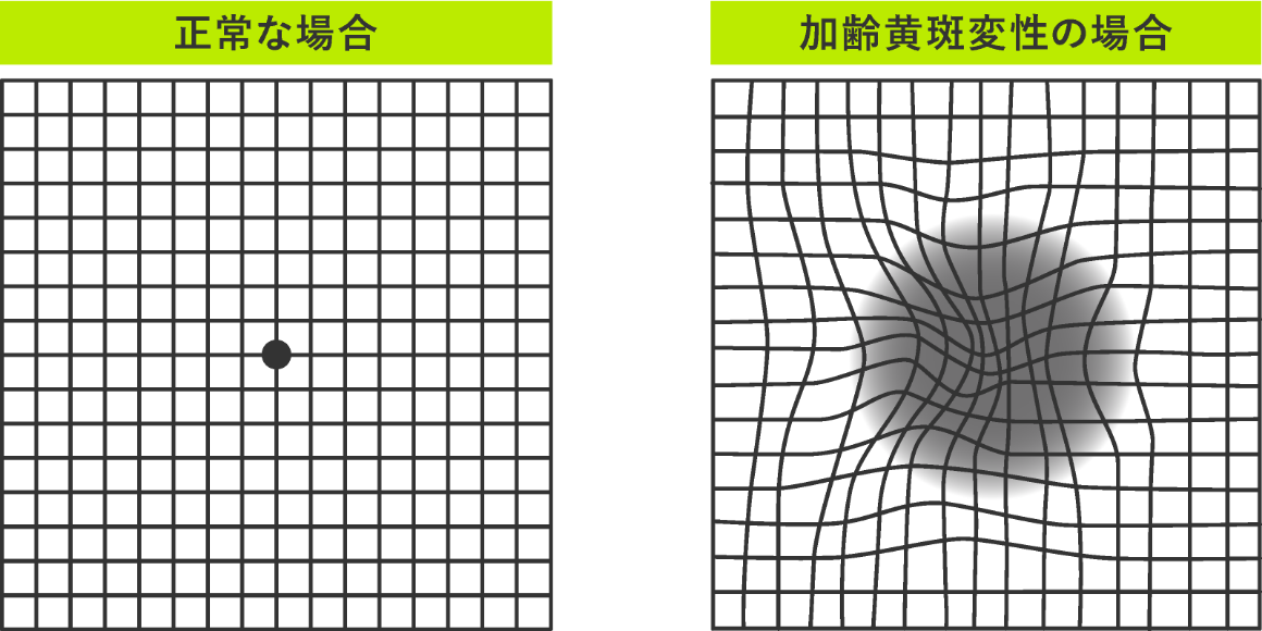 アムスラー検査