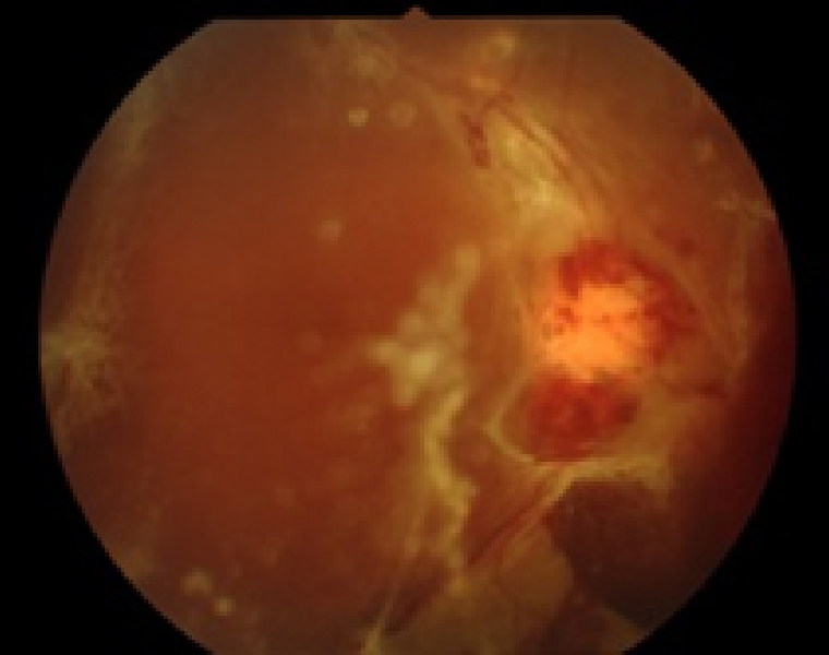 糖尿病網膜症とは