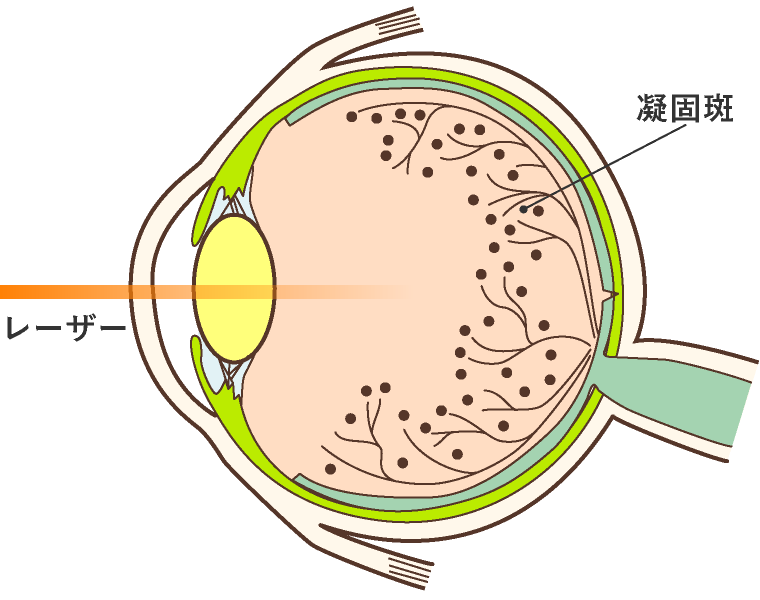 レーザー光凝固術