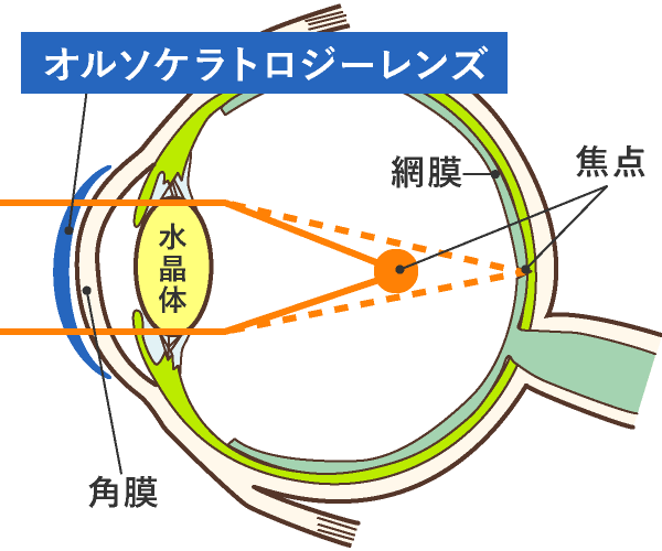 夜:レンズ装用中